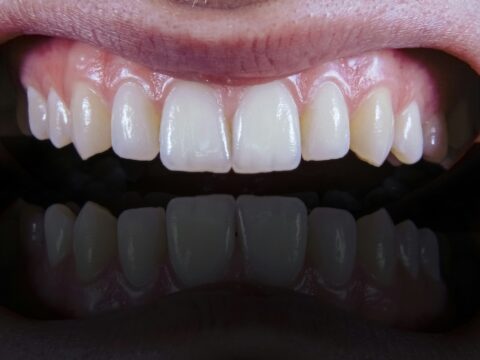 Can Oral Bacteria Make Heart Disease Worse?